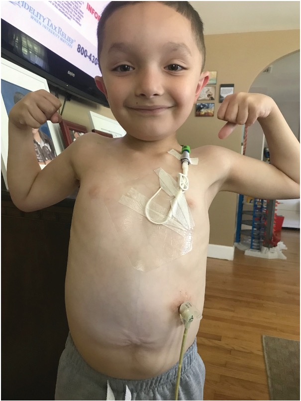 patient atteint de la maladie des inclusions microvillositaires (MVID) portant un cathéter veineux central type broviac