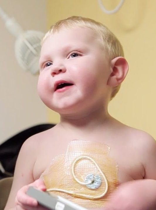 patient atteint de la maladie des inclusions microvillositaires (MVID) portant un cathéter veineux central type broviac